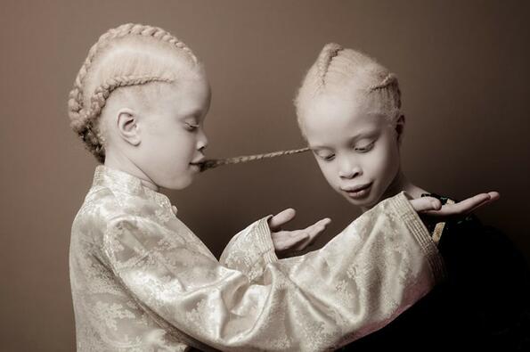 6 снимки на близначките албиноси, които станаха сензация в интернет!