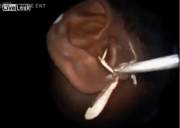 8 отвратителни насекоми, извадени от човешки уши (GIF)